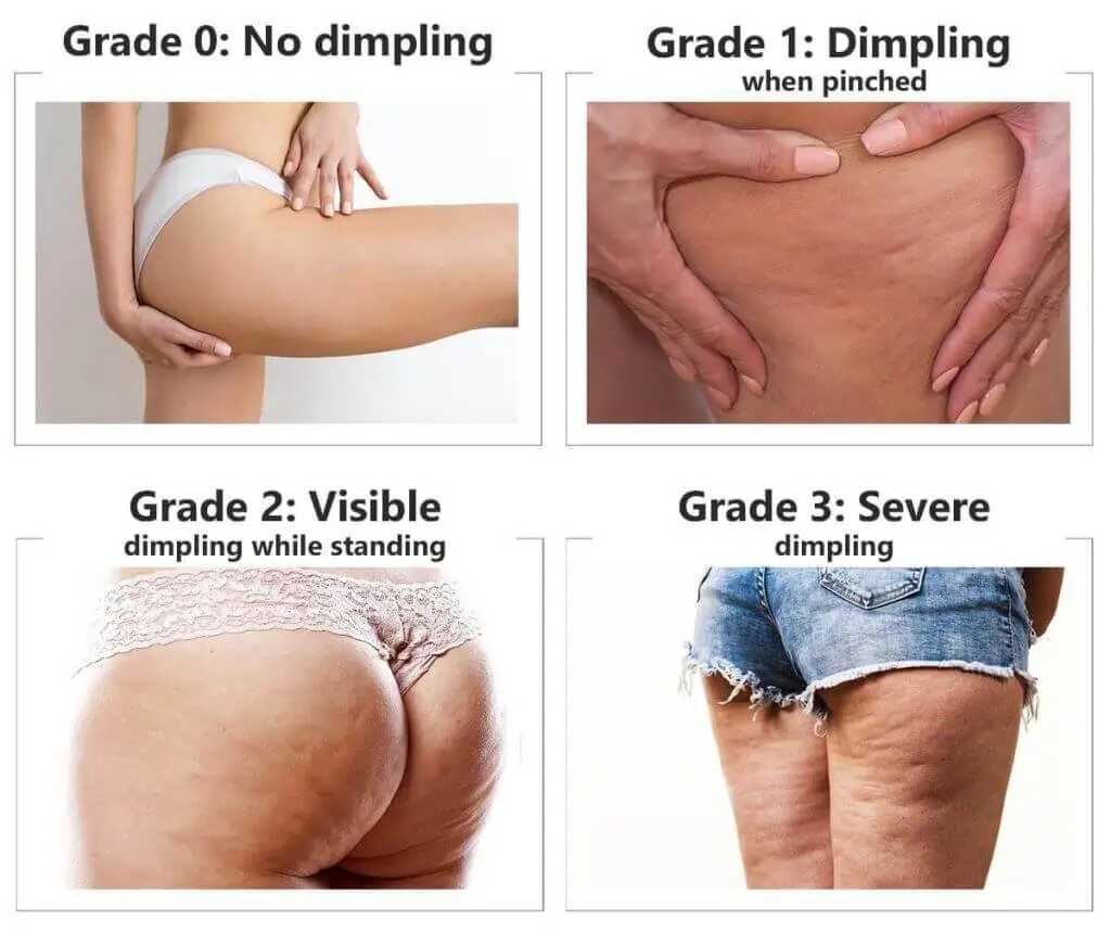 Representation of the stages of cellulite development Godalming